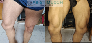 legs1year.PNG legs1year.PNG